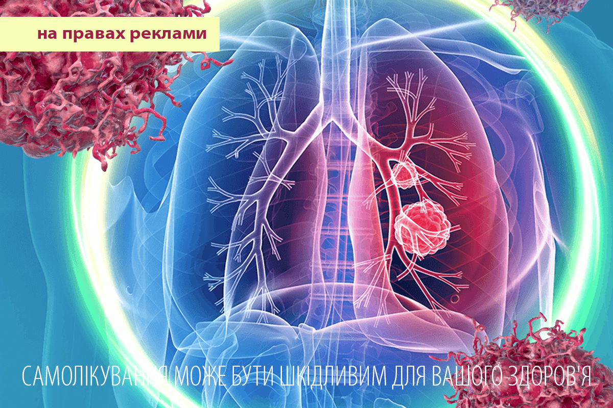 Комплексний погляд на рак легені: від типів і симптомів до факторів ризику та метастазів