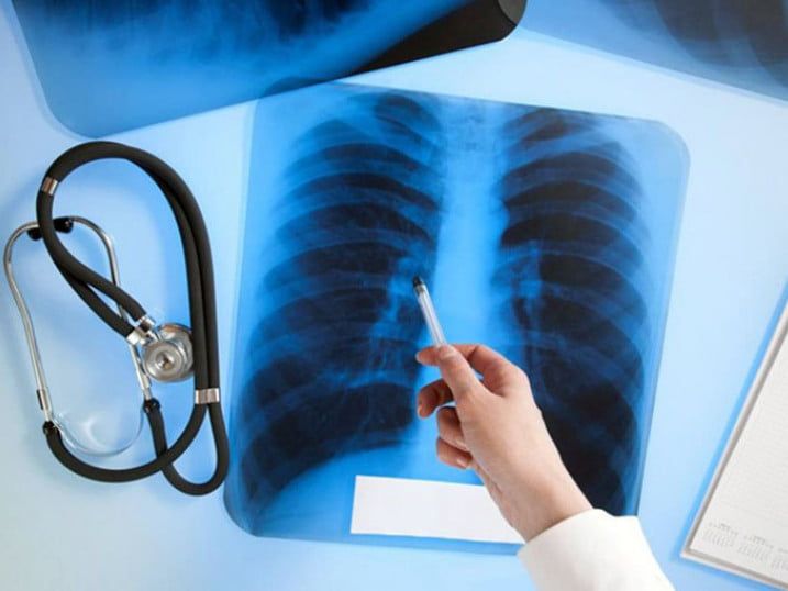 У Бердянську найнижчий показник захворювання на туберкульоз по області