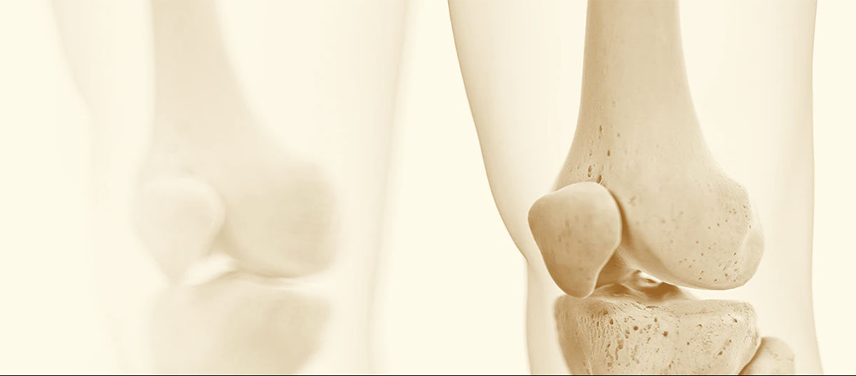 Артроз суставов: причины и лечение заболевания