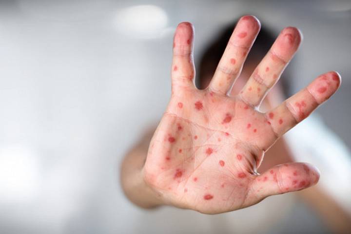 Спалах кору: медики закликають бердянців вакцинуватись