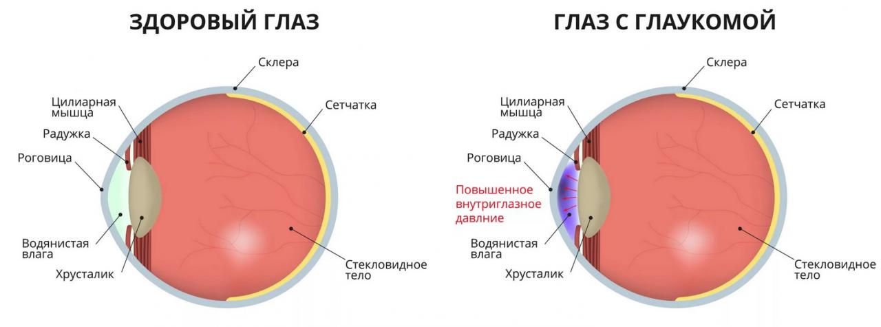 Глаукома: группы риска, причины, лечение