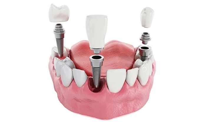 Имплантация зубов – какие технологии используются в Запорожье