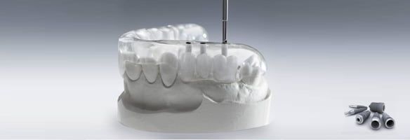 Современные технологии имплантации зубов 