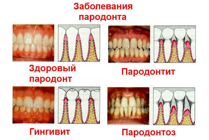 на схеме изображено сравнение болезней между пародонтозом и парадонтитом