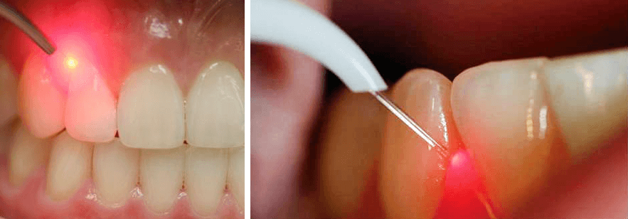 на фото изображены способы лечения пародонтоза при помощи специальных стоматологических инструментов 