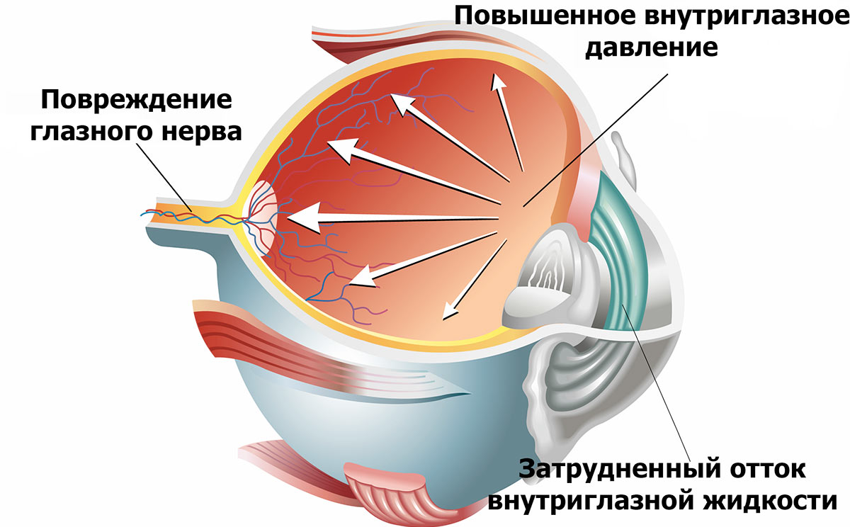 Глаукома