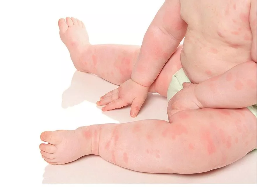 Атопический дерматит у детей: как помочь и какие препараты используют для лечения