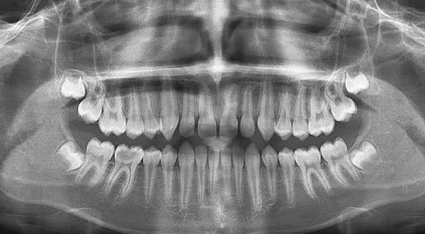 Панорамный снимок зубов или ортопантомограмма