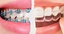 Современные методы улучшения внешнего вида зубов: капы, брекеты, виниры