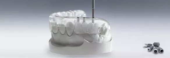 Современные технологии имплантации зубов 