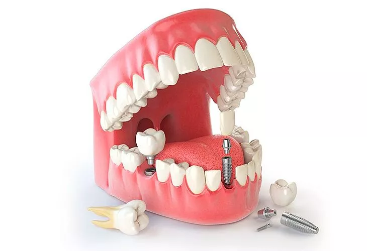 Имплантация зубов: показания, этапы, преимущества